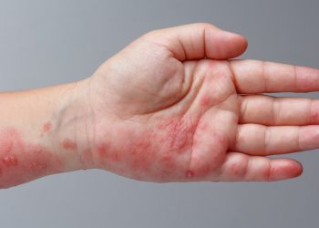Scabies Pada Kulit ,Ini Ciri- Ciri dan Cara Mengatasinya