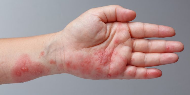 Scabies Pada Kulit ,Ini Ciri- Ciri dan Cara Mengatasinya