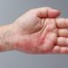 Scabies Pada Kulit ,Ini Ciri- Ciri dan Cara Mengatasinya