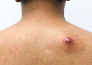 Bisul Penyebab dan Cara Mengobati Secara Alami