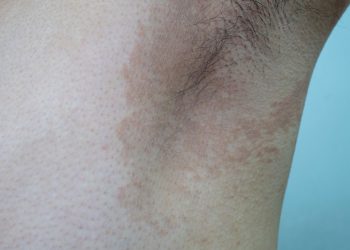 Cara Mengatasi Panu Secara Alami Pada Kulit