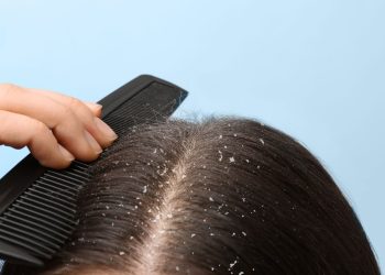 Cara Menghilangkan ketombe kering Secara Ampuh