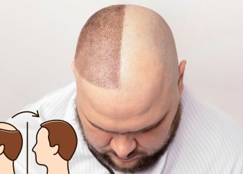 Arti Transplantasi Rambut , Tujuan Serta Efek Sampingnya