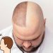 Arti Transplantasi Rambut , Tujuan Serta Efek Sampingnya