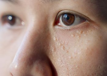 Tips Menghilangkan Milia di Wajah dengan Bahan Alami