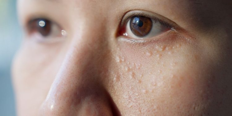 Tips Menghilangkan Milia di Wajah dengan Bahan Alami