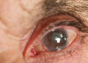 penyakit glaukoma Pengetian, Penyebab dan Pengobatannya