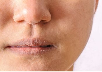 Cara Mengatasi Kulit Kering dan Kusam
