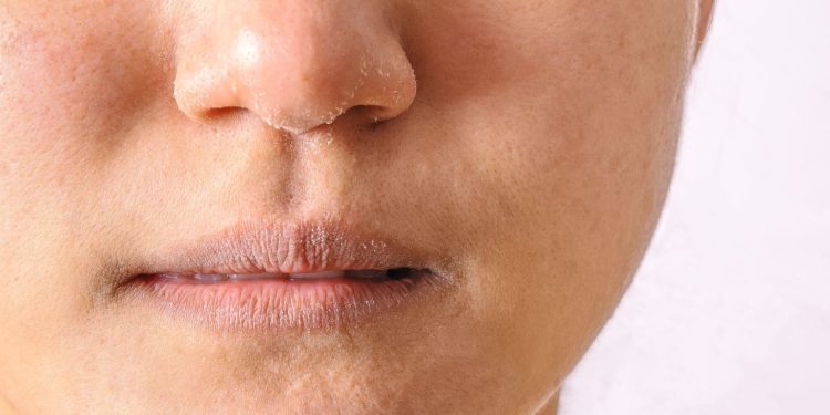 Cara Mengatasi Kulit Kering dan Kusam