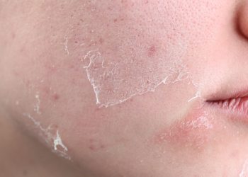 Cara Mengatasi Kulit Wajah Mengelupas dan Perih