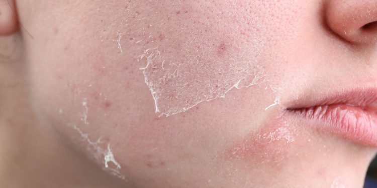 Cara Mengatasi Kulit Wajah Mengelupas dan Perih