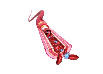 Penyebab Pembuluh Darah Pecah di Usia Muda