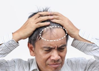 Rambut Rontok Akibat Stres Mitos atau Fakta