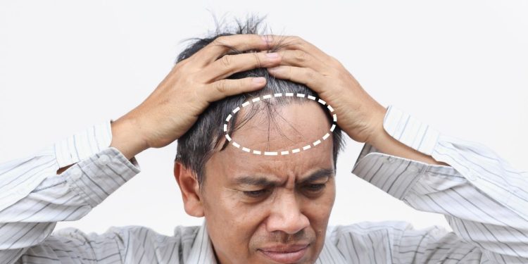 Rambut Rontok Akibat Stres Mitos atau Fakta