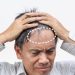 Rambut Rontok Akibat Stres Mitos atau Fakta