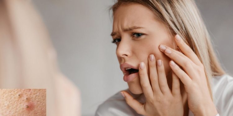 Komedo Membandel Atasi dengan Cara Alami Ini