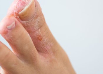 Penyebab Kutu Air dan Cara Mengatasinya