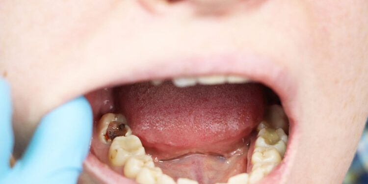 Kebiasaan Kecil Pencegah Gigi Berlubang yang Wajib Dilakukan Rutin