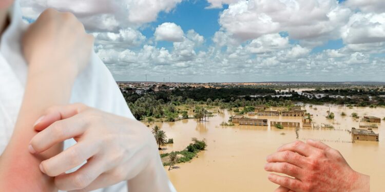 Cara Mengatasi Gatal-gatal Setelah Banjir dengan Cepat dan Aman