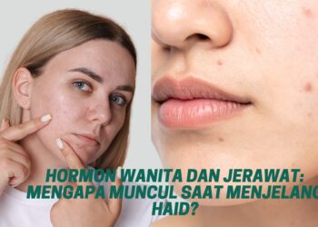 Hormon Wanita dan Jerawat Mengapa Muncul Saat Menjelang Haid