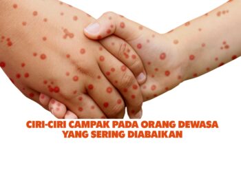 Ciri-Ciri Campak pada Orang Dewasa yang Sering Diabaikan