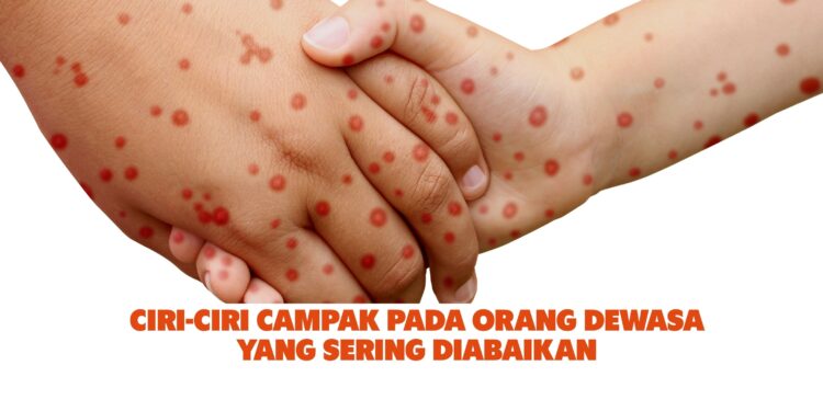 Ciri-Ciri Campak pada Orang Dewasa yang Sering Diabaikan