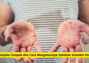 Gejala Campak dan Cara Mengatasinya Sebelum Semakin Parah