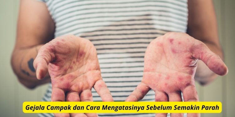 Gejala Campak dan Cara Mengatasinya Sebelum Semakin Parah