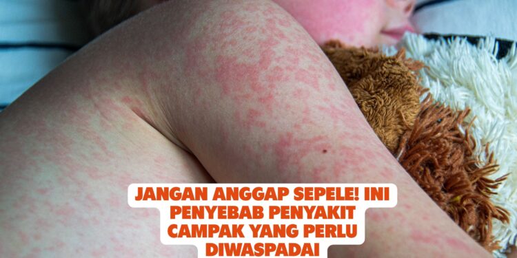Jangan Anggap Sepele! Ini Penyebab Penyakit Campak yang Perlu Diwaspadai