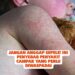 Jangan Anggap Sepele! Ini Penyebab Penyakit Campak yang Perlu Diwaspadai