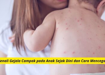 Kenali Gejala Campak pada Anak Sejak Dini dan Cara Mencegahnya