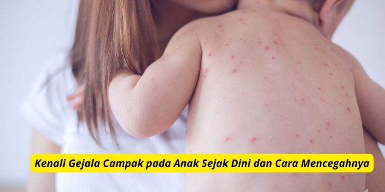 Kenali Gejala Campak pada Anak Sejak Dini dan Cara Mencegahnya