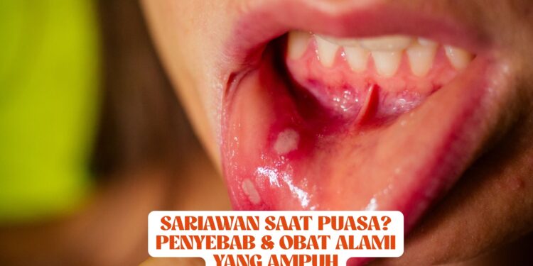 Sariawan Saat Puasa? Penyebab & Obat Alami yang Ampuh