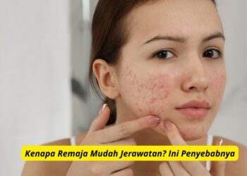 Kenapa Remaja Mudah Jerawatan? Ini Penyebabnya