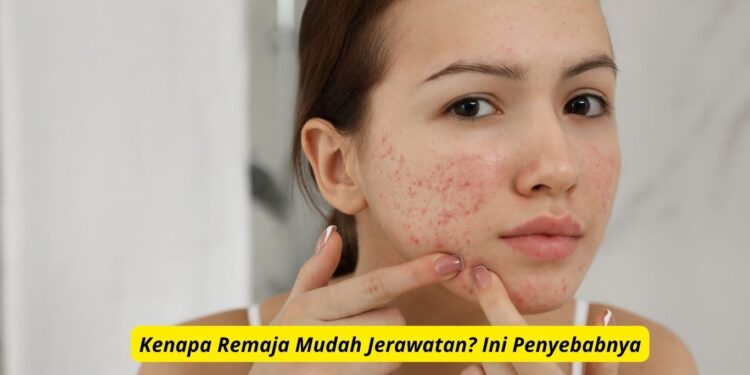 Kenapa Remaja Mudah Jerawatan? Ini Penyebabnya